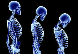 5 способов борьбы с остеопорозом! А Вы знали?